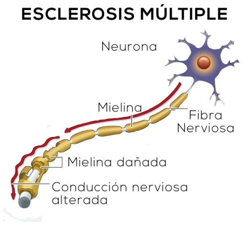 Gráfico ilustrativo de la esclerosis múltiple