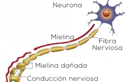 Gráfico ilustrativo de la esclerosis múltiple