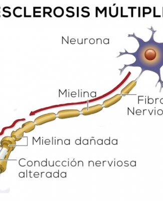 Gráfico ilustrativo de la esclerosis múltiple